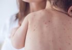 Nine more children die after showing measles symptoms