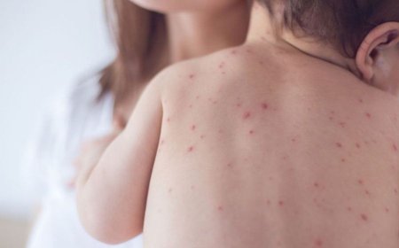 Nine more children die after showing measles symptoms