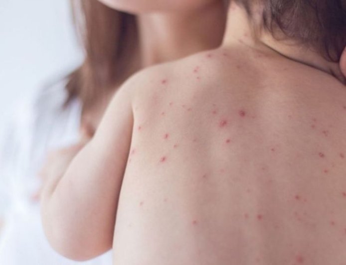 Nine more children die after showing measles symptoms