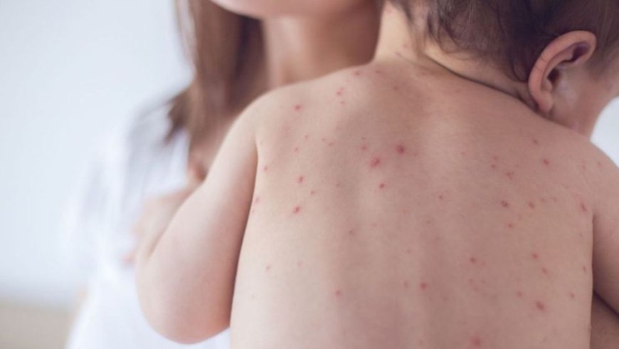 Nine more children die after showing measles symptoms