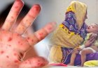 Five children die with measles-like symptoms within 24 hours