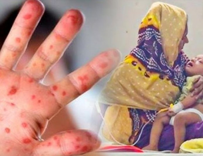 Five children die with measles-like symptoms within 24 hours