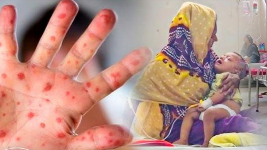 Five children die with measles-like symptoms within 24 hours